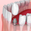 种植牙日常护理