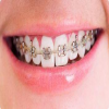 在深圳牙齿矫正会痛吗？