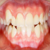 在深圳牙齿什么情况需要矫正？