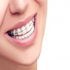 在深圳牙齿矫正后牙齿会不会很容易松动吗？