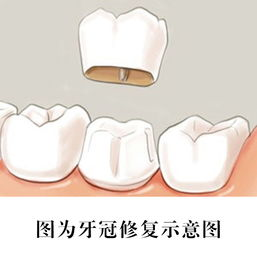 深圳种植牙的牙冠是什么？有哪些类型?