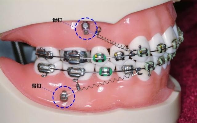 在深圳为什么矫正牙齿要打骨钉
