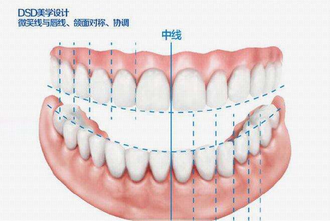 DSD微笑线设计