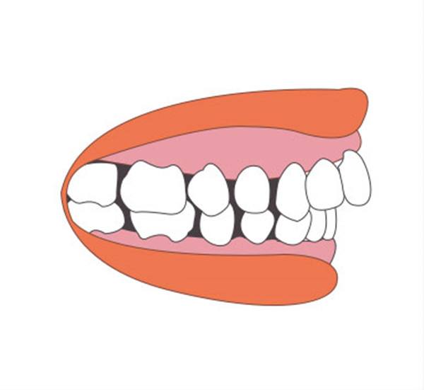 龅牙矫正时间受什么影响