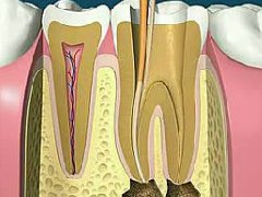 根管治疗中常见的问题