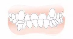 【深圳牙齿矫正】传说中的牙齿矫正出现“牙套脸”，