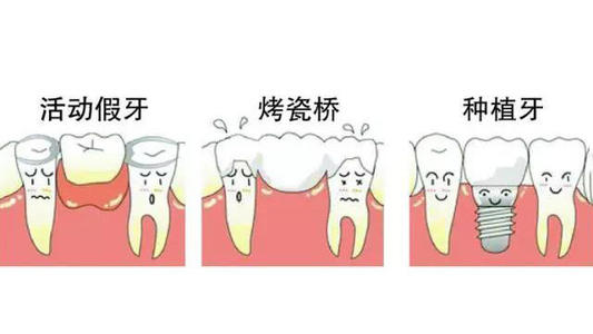 缺牙點解要鑲牙
