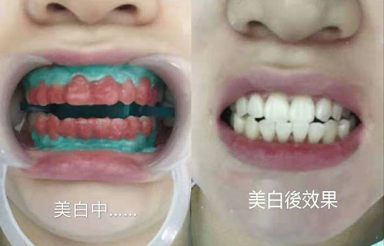 珠海皓齒美白收費