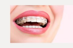 牙齿矫正的四个误区