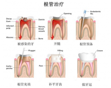 深圳牙科根管治疗步骤是怎样的？