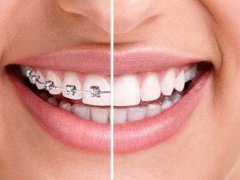 深圳牙齿矫正有什么风险后遗症？