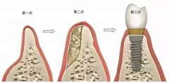 深圳种植牙为什么要植骨？